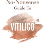 Vitiligo on hands